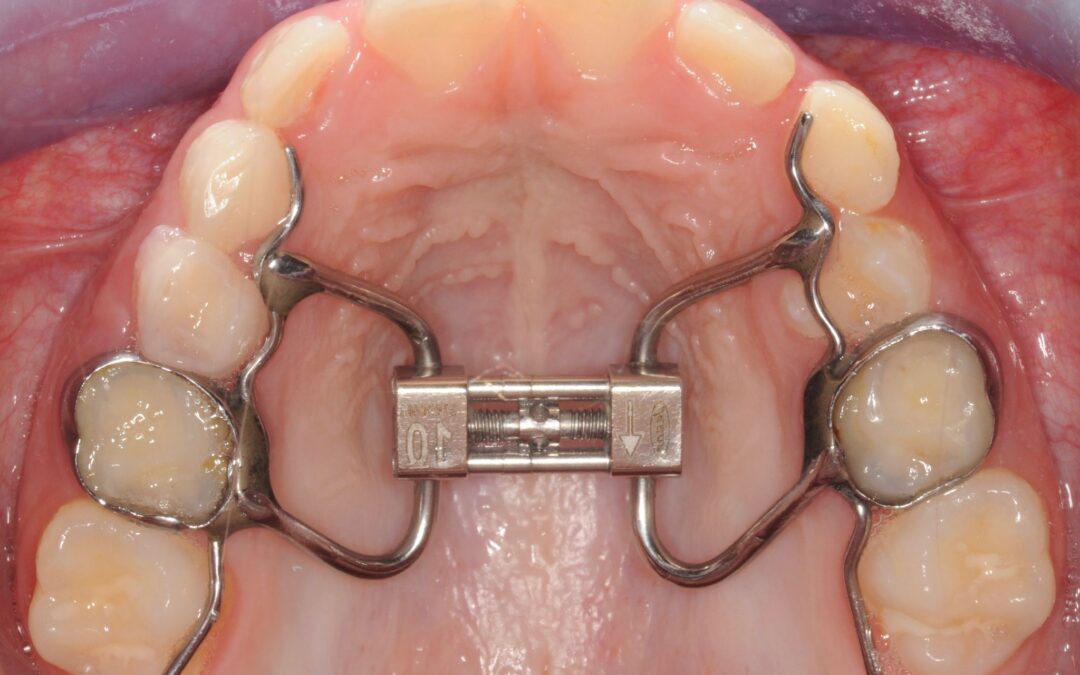 Apparecchio Ortodontico per Disabili