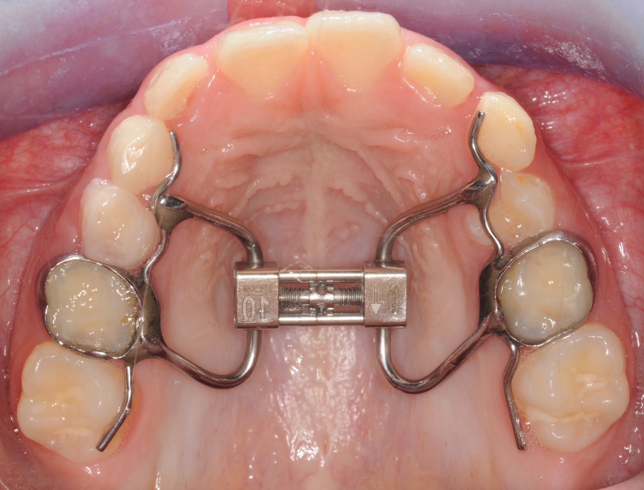 Allenatore Ortodontico Per Bambini – Apparecchio Per Allineamento Denti In 3 Fasi - Foto 2